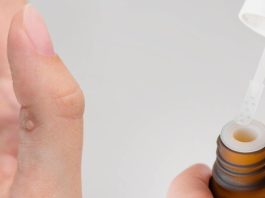 Warzen Hausmittel Teebaumöl Behandlung