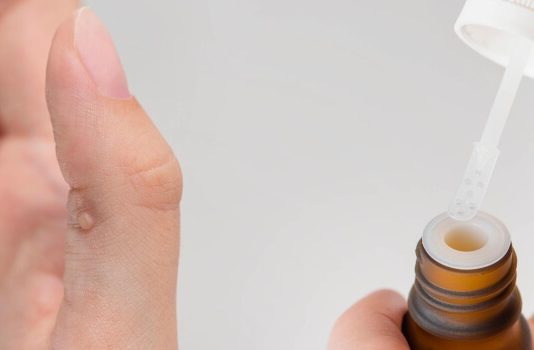 Warzen Hausmittel Teebaumöl Behandlung